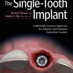 The Single-Tooth Implant: A Minimally Invasive Approach for Anterior and Posterior Extraction Sockets 1st Edition 2 The Single-Tooth Implant: A Minimally Invasive Approach for Anterior and Posterior Extraction Sockets 1st Edition